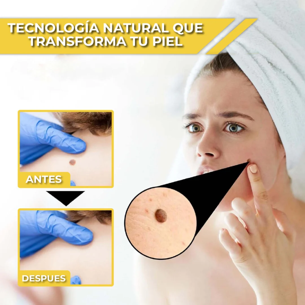 Despídete de las verrugas, lunares y marcas en la piel en 7 días, sin dolor y sin dejar marcas. 🐝